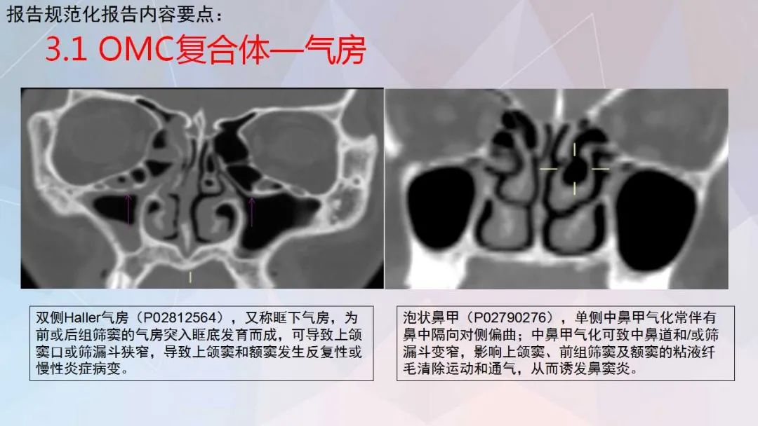 影像PPT - 【PPT】鼻窦CT评估与结构式报告-23