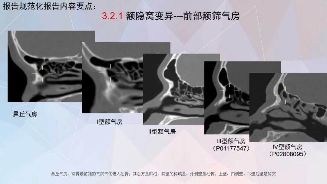 影像PPT - 【PPT】鼻窦CT评估与结构式报告-30