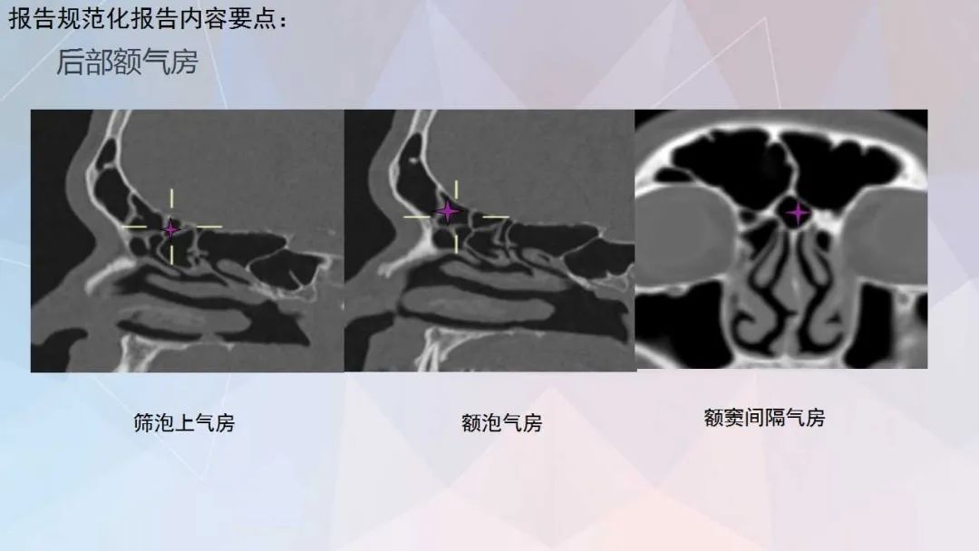 影像PPT - 【PPT】鼻窦CT评估与结构式报告-33