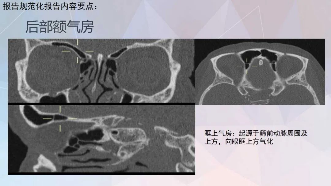 影像PPT - 【PPT】鼻窦CT评估与结构式报告-32