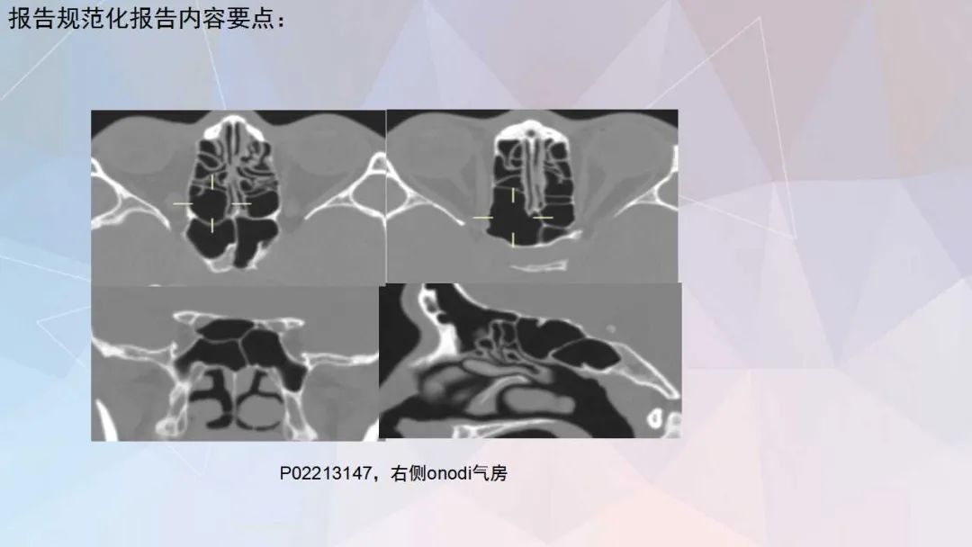 影像PPT - 【PPT】鼻窦CT评估与结构式报告-39