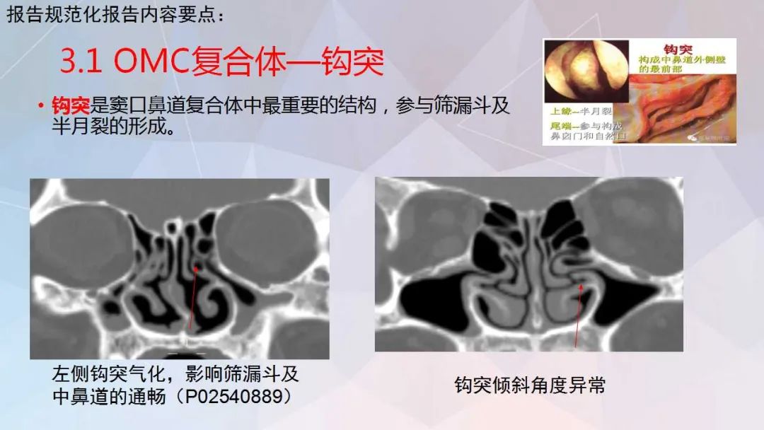 影像PPT - 【PPT】鼻窦CT评估与结构式报告-25