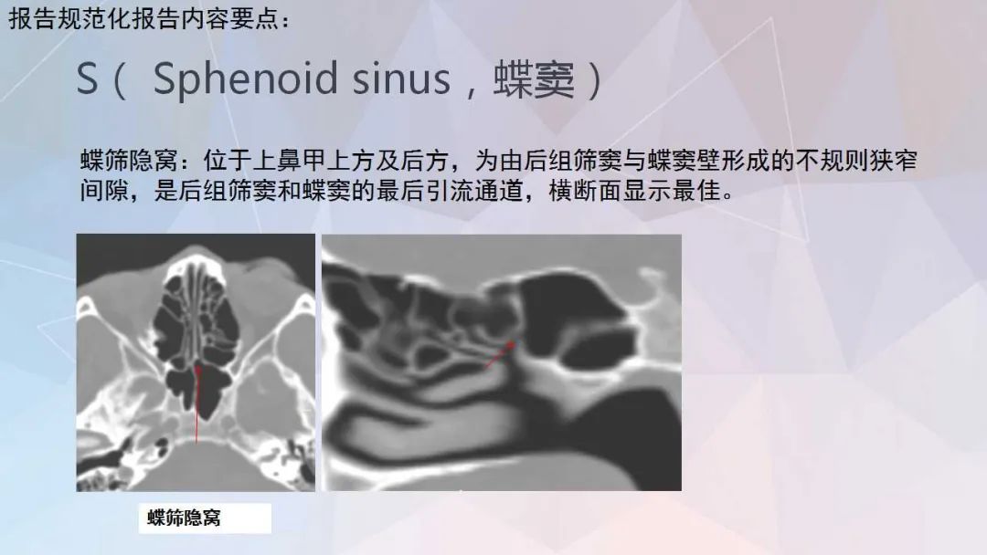 影像PPT - 【PPT】鼻窦CT评估与结构式报告-40