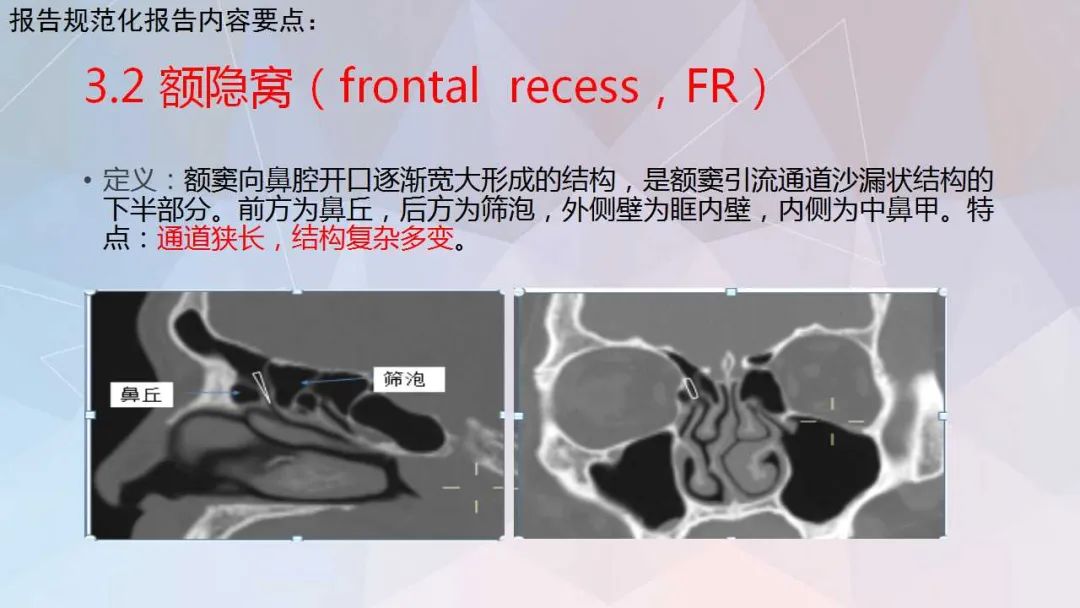 影像PPT - 【PPT】鼻窦CT评估与结构式报告-28
