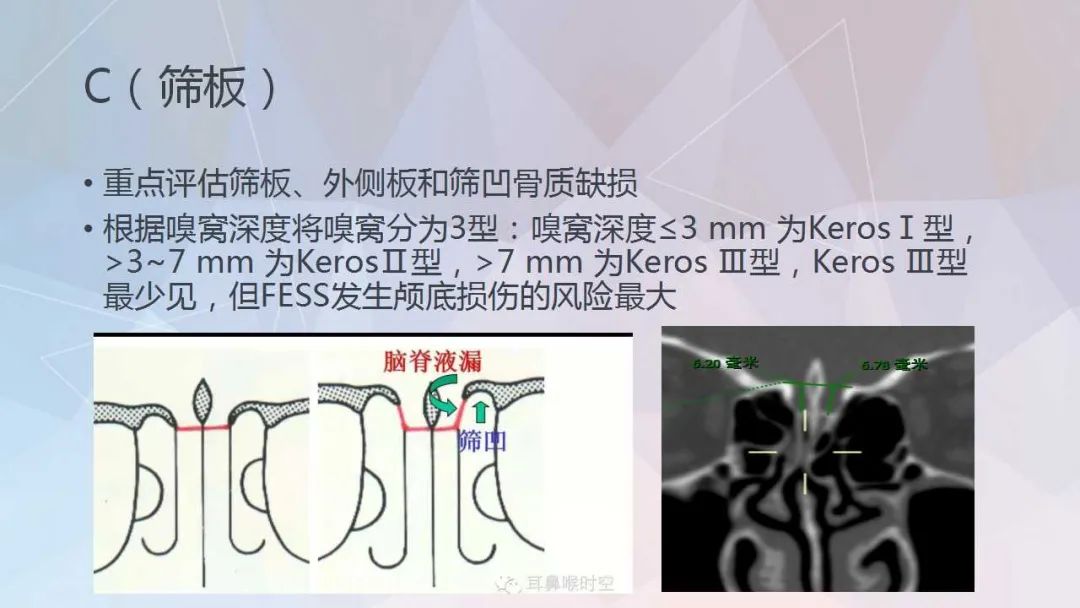 影像PPT - 【PPT】鼻窦CT评估与结构式报告-36
