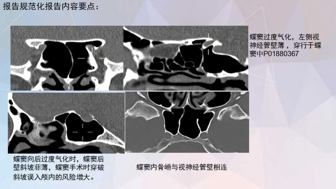 影像PPT - 【PPT】鼻窦CT评估与结构式报告-41