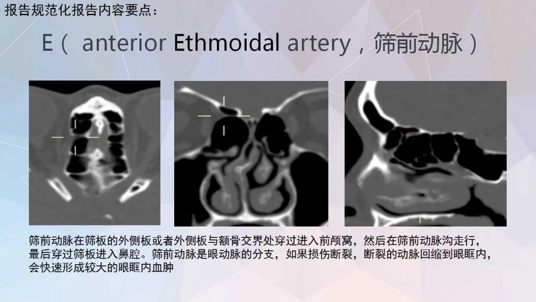 影像PPT - 【PPT】鼻窦CT评估与结构式报告-43