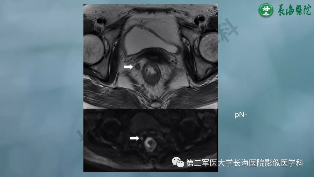 影像PPT - 【PPT】CRC淋巴结良恶性评估-15