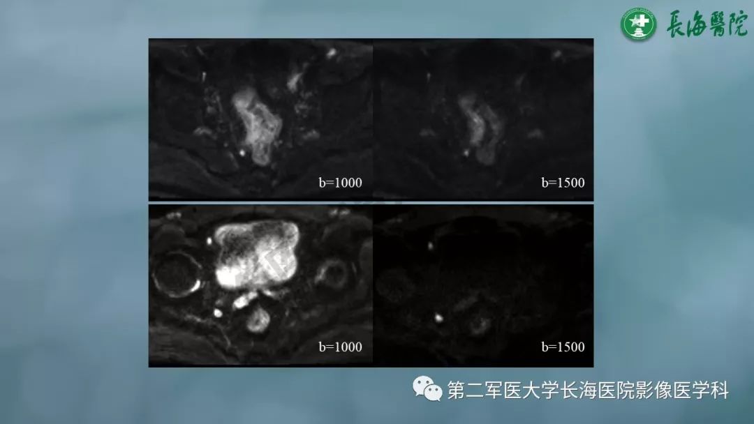 影像PPT - 【PPT】CRC淋巴结良恶性评估-16