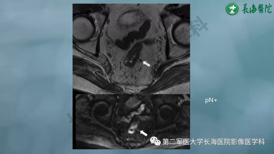 影像PPT - 【PPT】CRC淋巴结良恶性评估-14