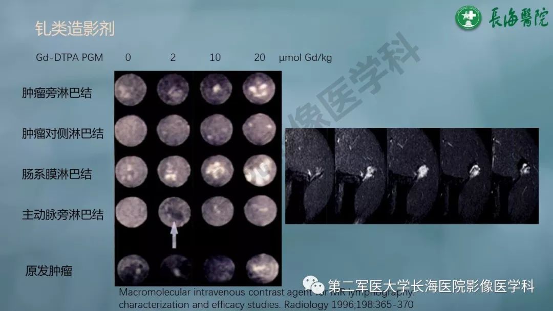 影像PPT - 【PPT】CRC淋巴结良恶性评估-22