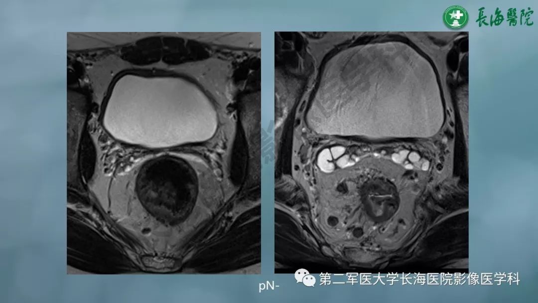 影像PPT - 【PPT】CRC淋巴结良恶性评估-10