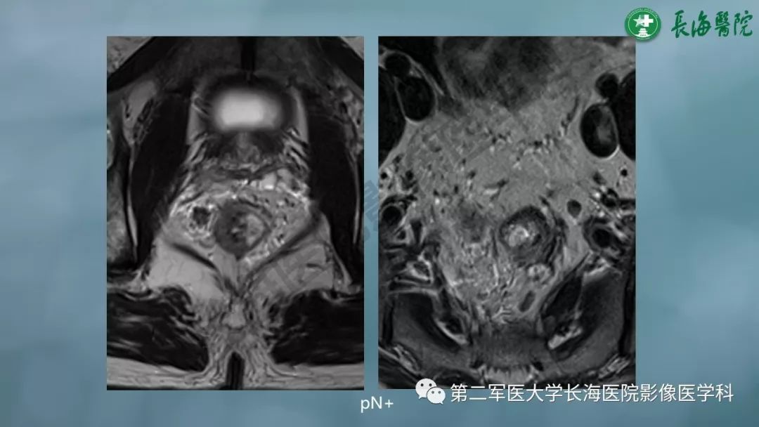影像PPT - 【PPT】CRC淋巴结良恶性评估-11