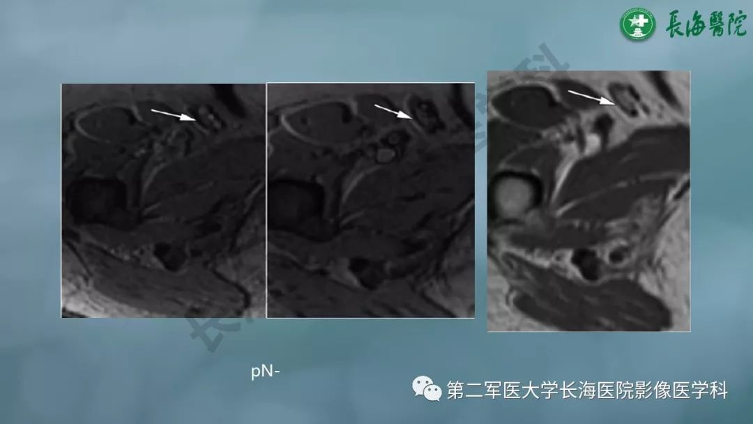 影像PPT - 【PPT】CRC淋巴结良恶性评估-34