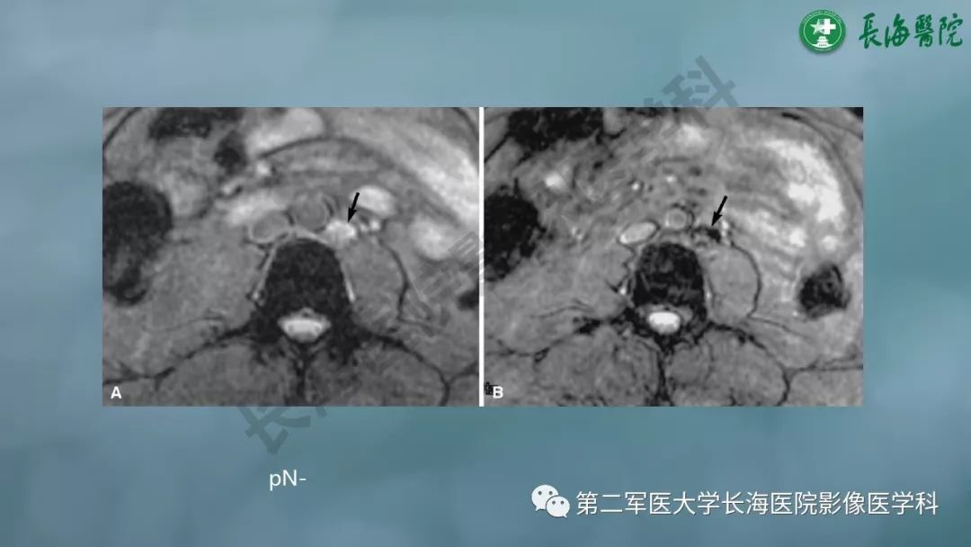 影像PPT - 【PPT】CRC淋巴结良恶性评估-35