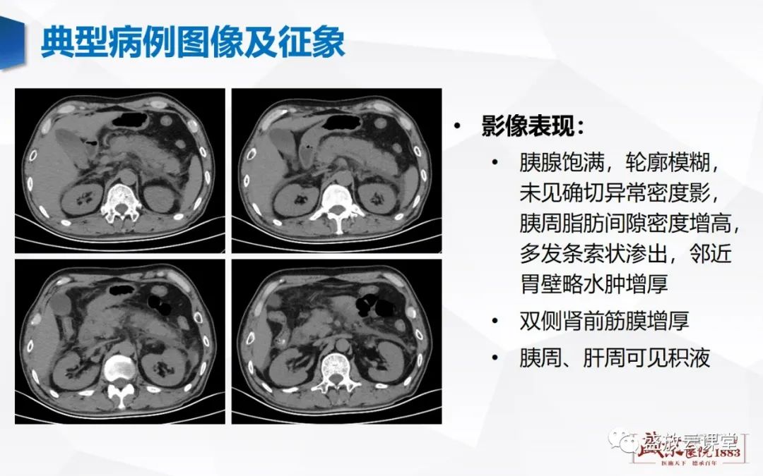 影像PPT - 【PPT】胰腺病变（胰腺炎）-4