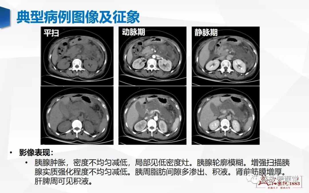 影像PPT - 【PPT】胰腺病变（胰腺炎）-7
