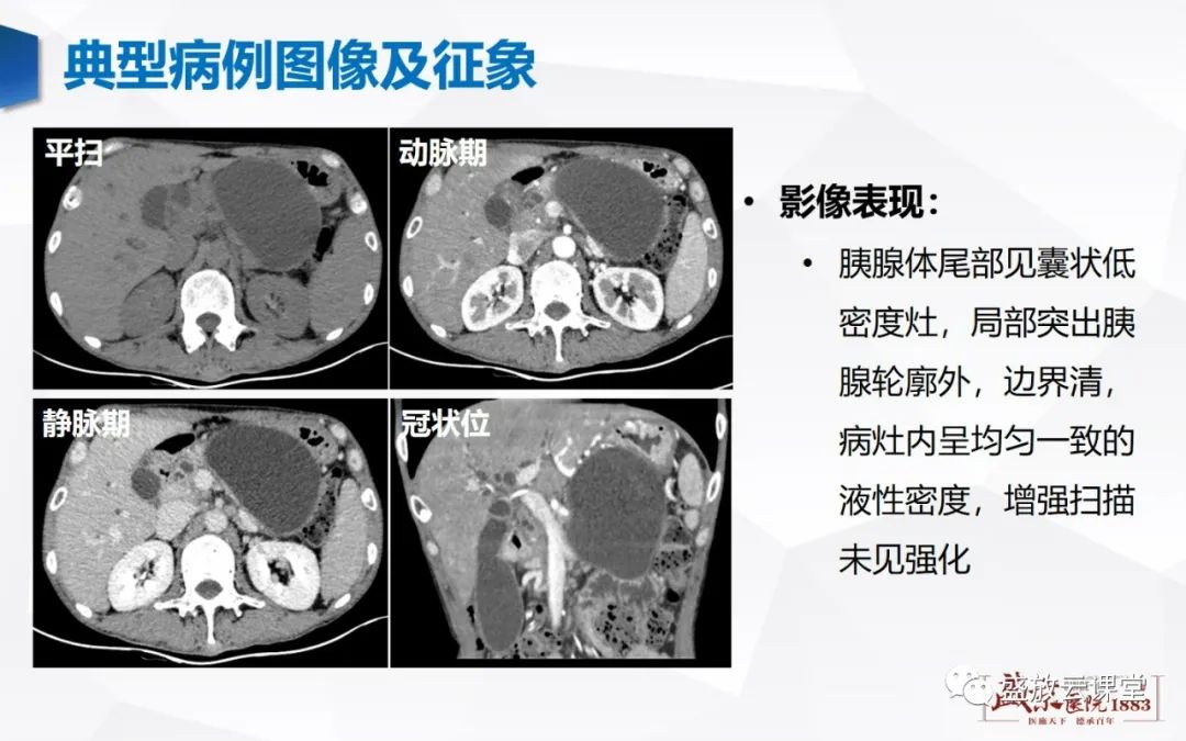 影像PPT - 【PPT】胰腺病变（胰腺炎）-10