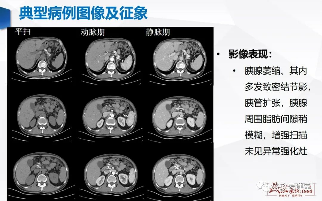 影像PPT - 【PPT】胰腺病变（胰腺炎）-17