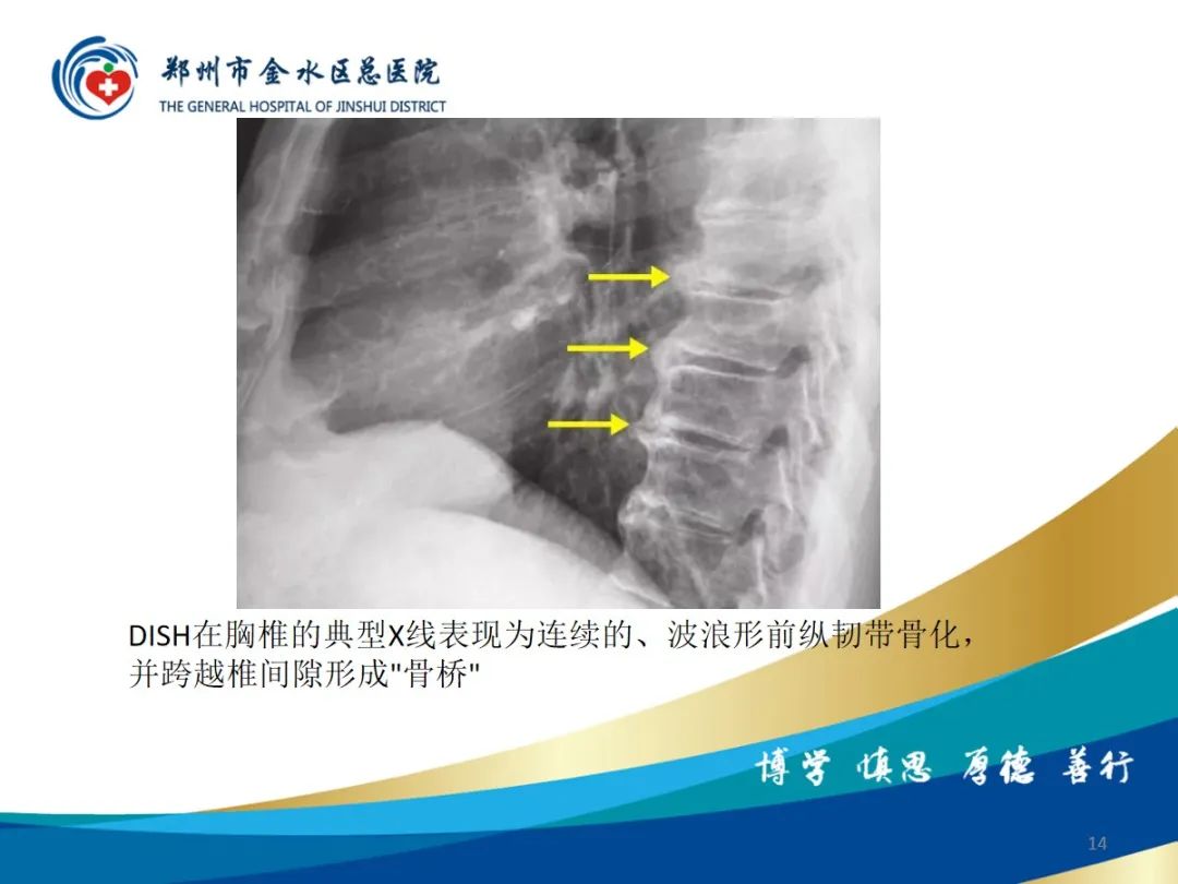 影像PPT - 【PPT】弥漫性特发性骨肥厚症（DISH）-14