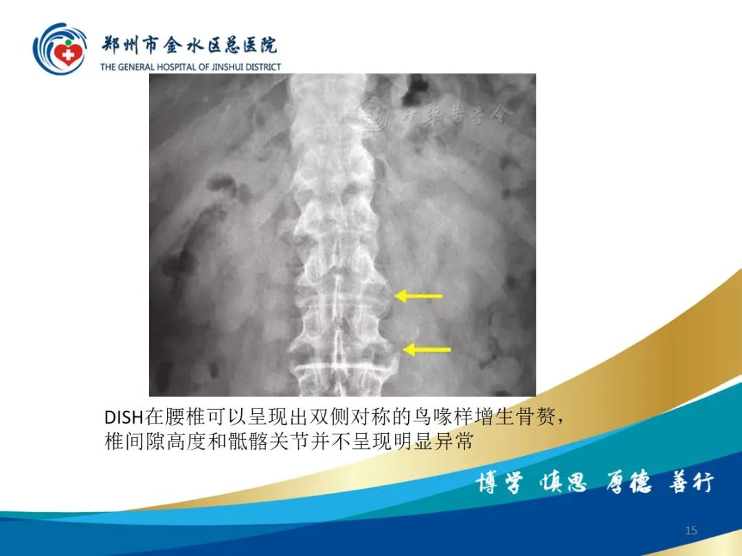 影像PPT - 【PPT】弥漫性特发性骨肥厚症（DISH）-15