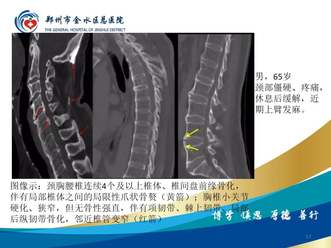 影像PPT - 【PPT】弥漫性特发性骨肥厚症（DISH）-17