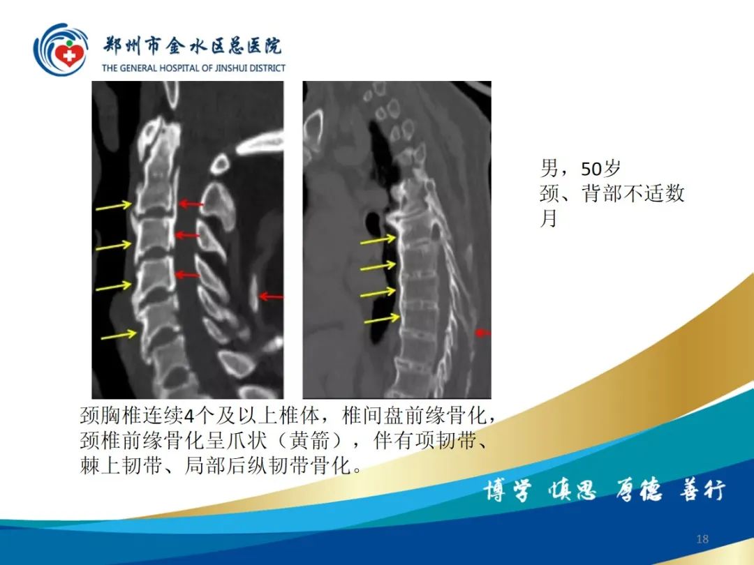 影像PPT - 【PPT】弥漫性特发性骨肥厚症（DISH）-18