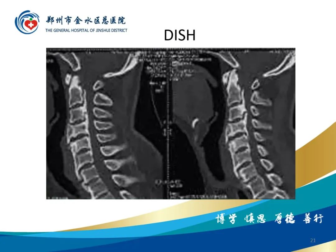 影像PPT - 【PPT】弥漫性特发性骨肥厚症（DISH）-21