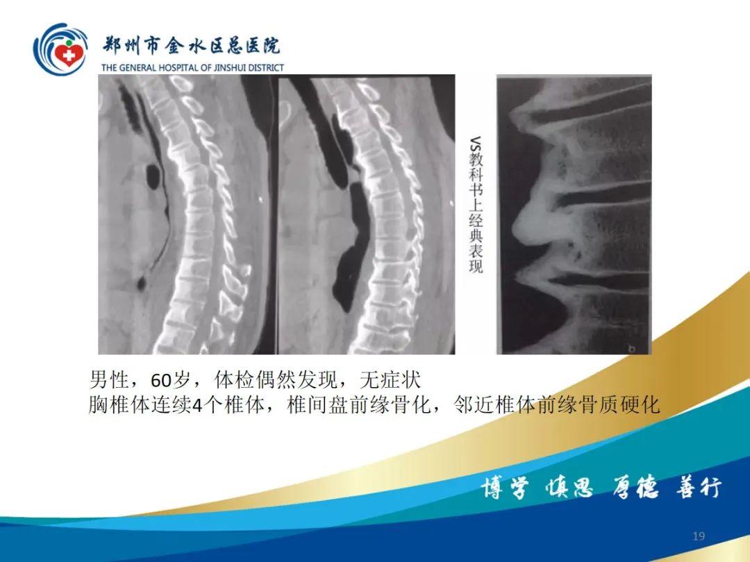 影像PPT - 【PPT】弥漫性特发性骨肥厚症（DISH）-19