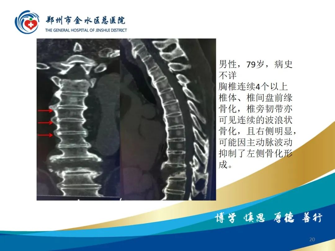 影像PPT - 【PPT】弥漫性特发性骨肥厚症（DISH）-20