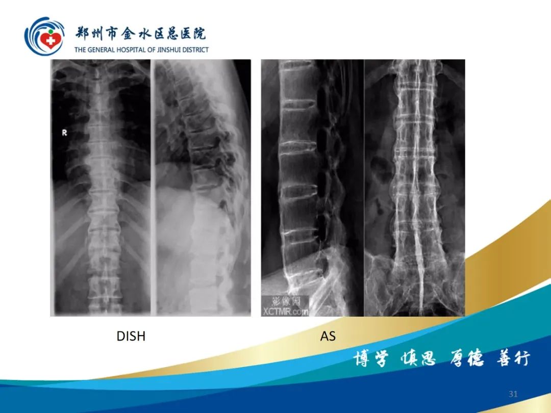 影像PPT - 【PPT】弥漫性特发性骨肥厚症（DISH）-31