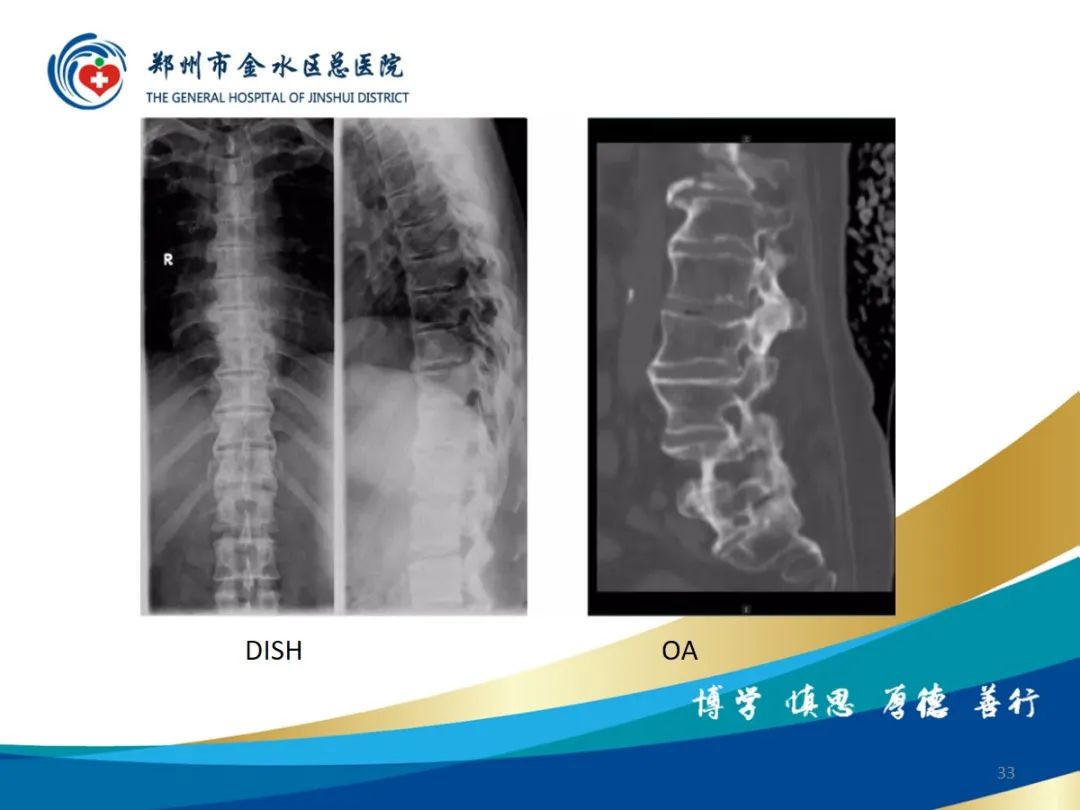 影像PPT - 【PPT】弥漫性特发性骨肥厚症（DISH）-33