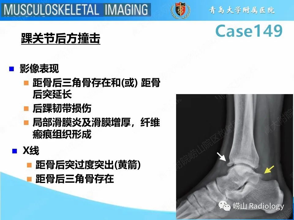 影像PPT - 【PPT】三角骨综合征-7