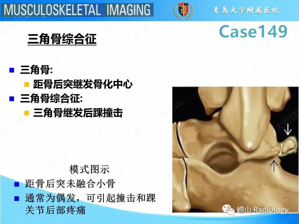 影像PPT - 【PPT】三角骨综合征-6