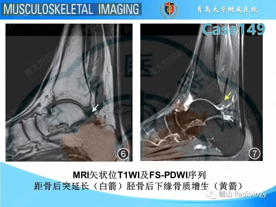 影像PPT - 【PPT】三角骨综合征-9