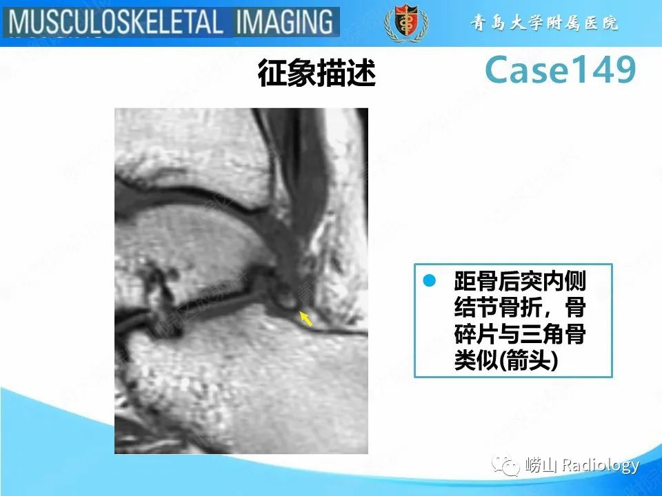 影像PPT - 【PPT】三角骨综合征-13