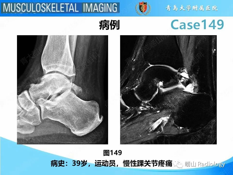 影像PPT - 【PPT】三角骨综合征-2