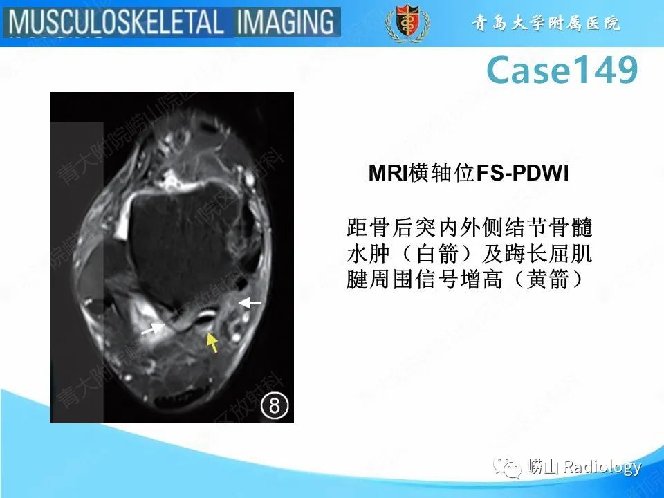 影像PPT - 【PPT】三角骨综合征-10