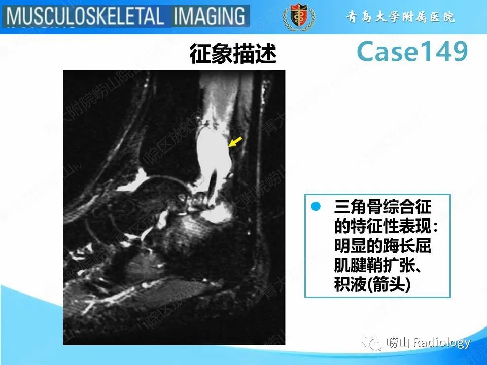 影像PPT - 【PPT】三角骨综合征-12