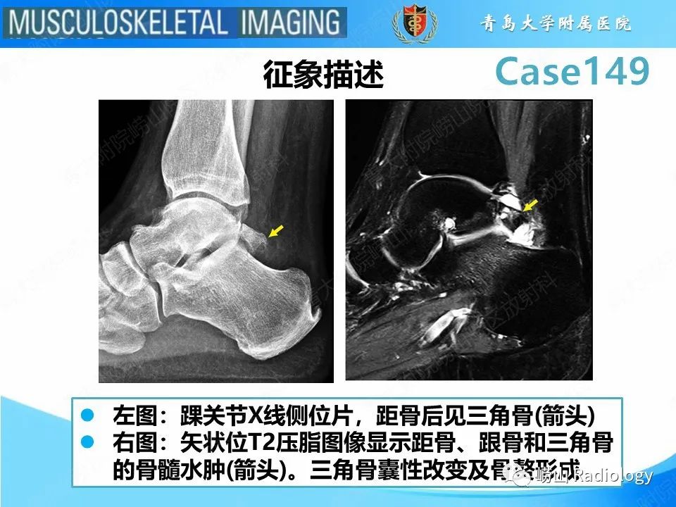 影像PPT - 【PPT】三角骨综合征-11