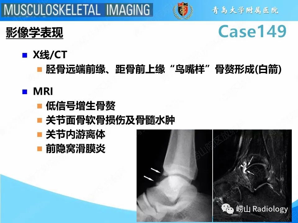 影像PPT - 【PPT】三角骨综合征-22