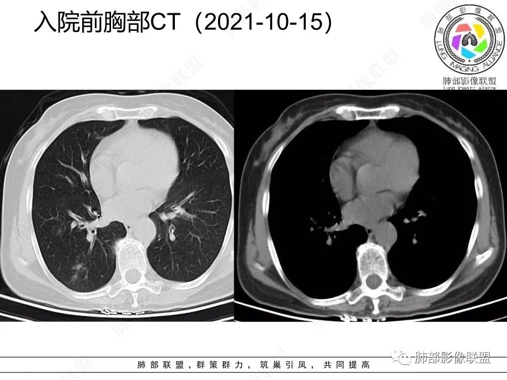 影像PPT - 【每日晨读】如此结核,无愧“妖中之王”!-7 影像PPT - 【每日晨读】如此结核,无愧“妖中之王”!-7