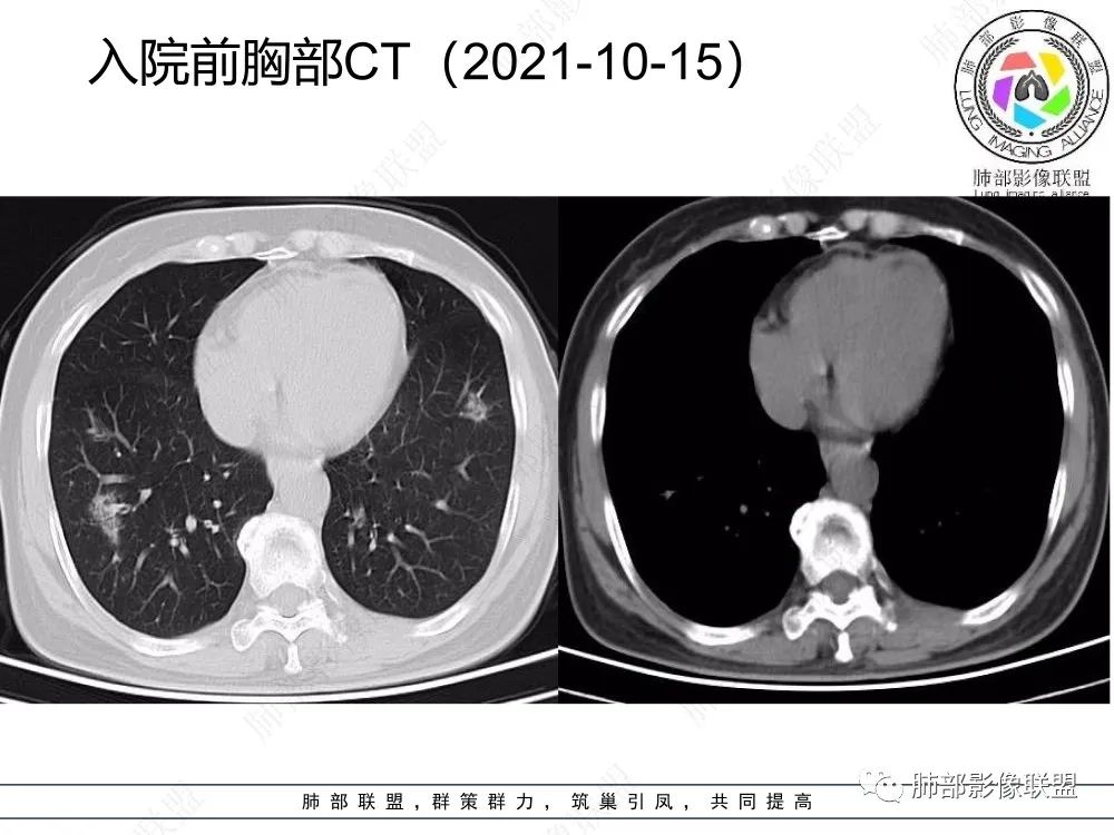 影像PPT - 【每日晨读】如此结核,无愧“妖中之王”!-10 影像PPT - 【每日晨读】如此结核,无愧“妖中之王”!-10