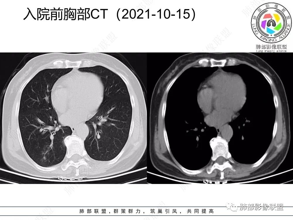 影像PPT - 【每日晨读】如此结核,无愧“妖中之王”!-8 影像PPT - 【每日晨读】如此结核,无愧“妖中之王”!-8