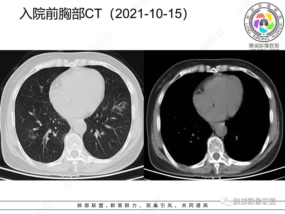 影像PPT - 【每日晨读】如此结核,无愧“妖中之王”!-9 影像PPT - 【每日晨读】如此结核,无愧“妖中之王”!-9