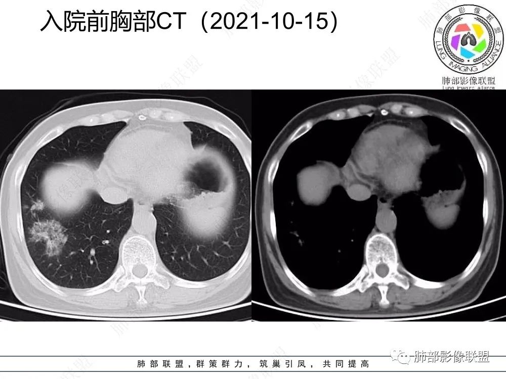 影像PPT - 【每日晨读】如此结核,无愧“妖中之王”!-13 影像PPT - 【每日晨读】如此结核,无愧“妖中之王”!-13