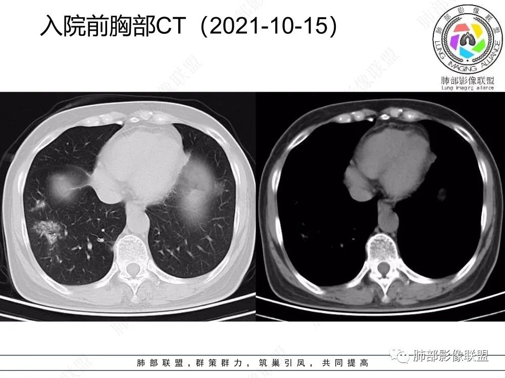 影像PPT - 【每日晨读】如此结核,无愧“妖中之王”!-12 影像PPT - 【每日晨读】如此结核,无愧“妖中之王”!-12