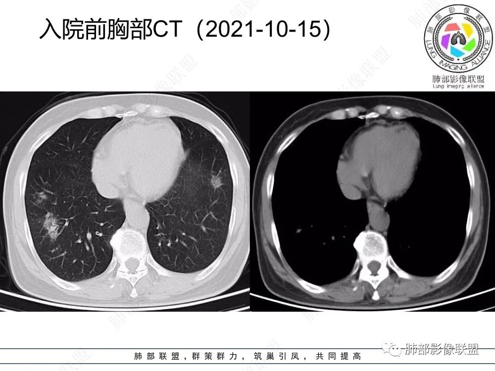 影像PPT - 【每日晨读】如此结核,无愧“妖中之王”!-11 影像PPT - 【每日晨读】如此结核,无愧“妖中之王”!-11
