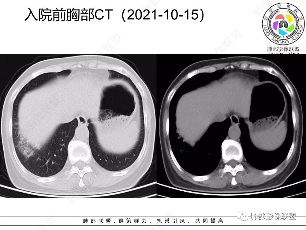 影像PPT - 【每日晨读】如此结核,无愧“妖中之王”!-15 影像PPT - 【每日晨读】如此结核,无愧“妖中之王”!-15