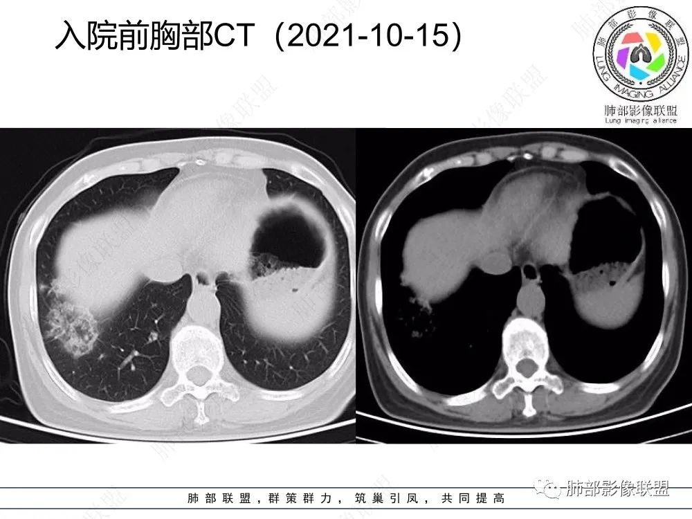 影像PPT - 【每日晨读】如此结核,无愧“妖中之王”!-14 影像PPT - 【每日晨读】如此结核,无愧“妖中之王”!-14